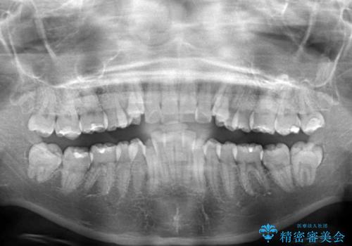 目立たない裏側矯正 抜歯矯正で口元を改善の治療前