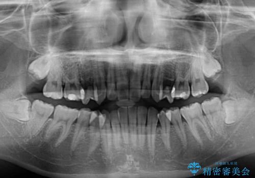 奥歯の反対咬合 上顎骨を拡大してインビザラインで矯正の治療前