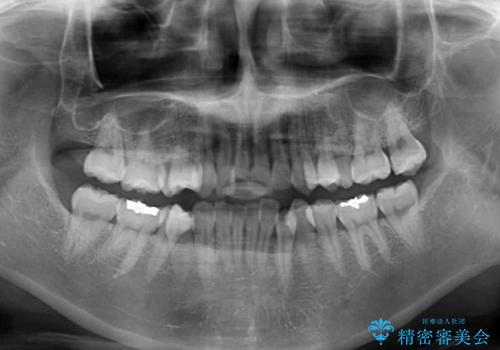 インビザラインで機能面に問題のある歯列を改善の治療前