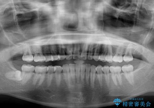インビザラインによる軽度な出っ歯の矯正治療の治療前