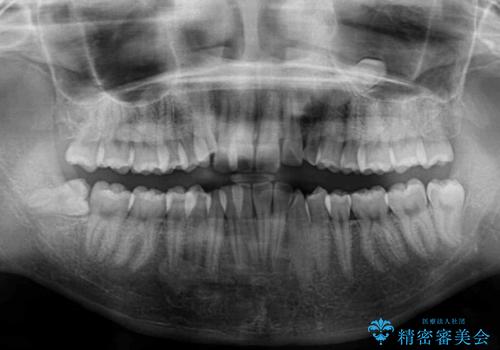 インビザライン矯正とインプラント治療と 総合歯科治療の治療前