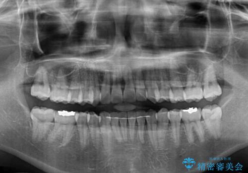 インビザラインで機能面に問題のある歯列を改善の治療後