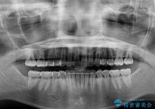 インビザラインによる軽度な出っ歯の矯正治療の治療後