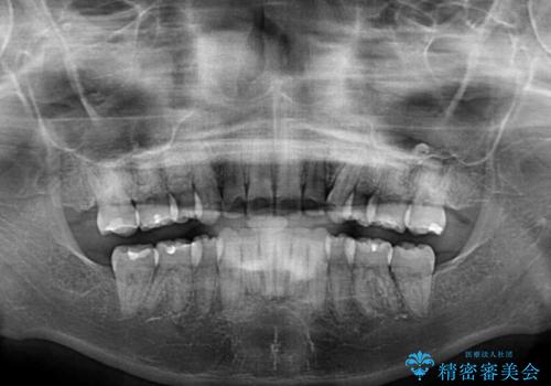 目立たない裏側矯正 抜歯矯正で口元を改善の治療後