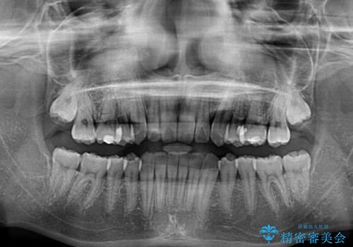 奥歯の反対咬合 上顎骨を拡大してインビザラインで矯正の治療後