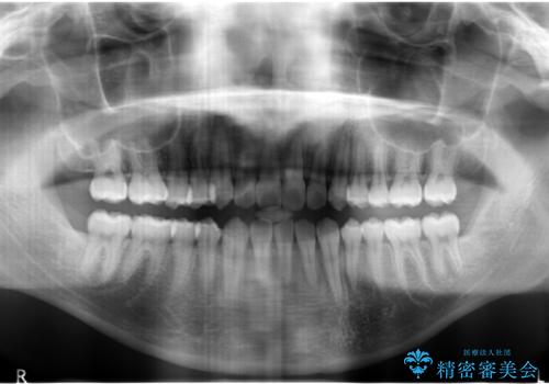 インビザライン矯正　神経のない歯をとって、全て天然歯に　の治療後