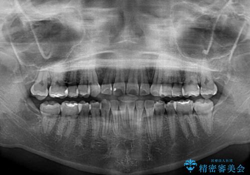 埋もれた八重歯を引っ張り出す　目立たない矯正装置の治療後