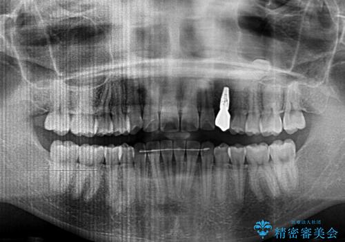 インビザライン矯正とインプラント治療と 総合歯科治療の治療後