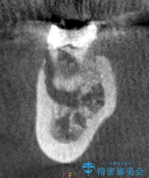 歯ぐきの腫れが治らない 石灰化した狭小根管治療の治療前