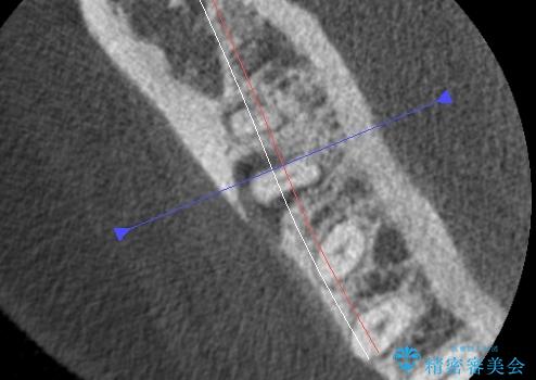 歯ぐきの腫れが治らない 石灰化した狭小根管治療の治療中