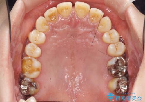 目立つ銀歯を白くしたい　セラミック治療の症例 治療前