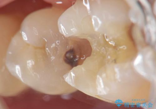 保険適応の白い詰め物レジンインレー下に再発した大きな虫歯治療の治療中
