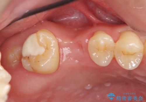 ソケットリフトを伴うインプラント補綴 の治療前