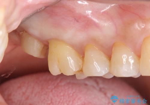 歯髄方向 歯肉方向へと深い 2種類の大きな虫歯の治療中