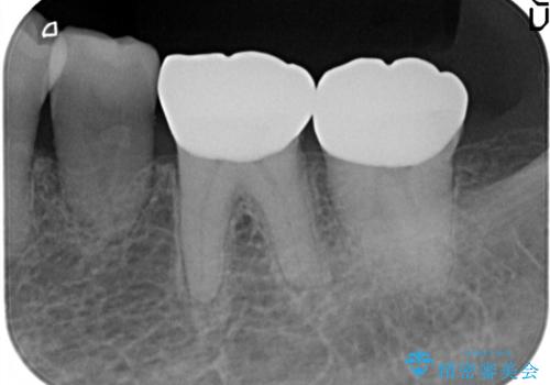 奥歯の被せ物をしたい。しみる奥歯、アイスを食べたい。の治療後