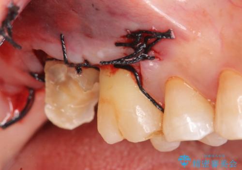 歯髄方向 歯肉方向へと深い 2種類の大きな虫歯の治療後