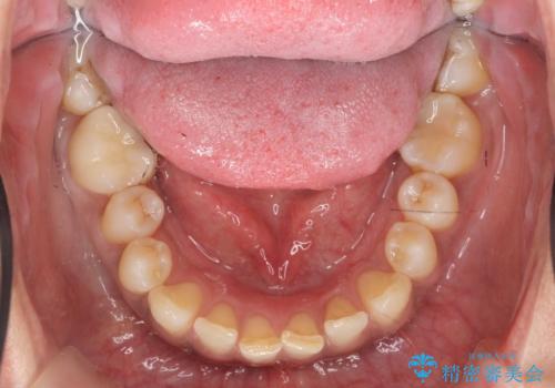 目立つ銀歯を白くしたい セラミック治療の治療後