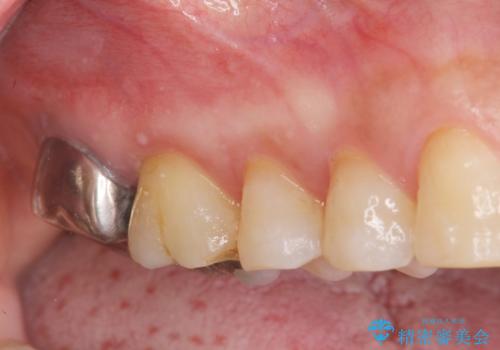 歯髄方向　歯肉方向へと深い 2種類の大きな虫歯の症例 治療前