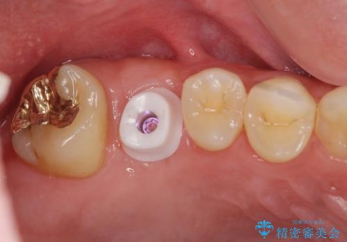 ソケットリフトを伴うインプラント補綴 の治療中
