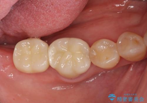 奥歯　インプラントによる機能回復の症例 治療後