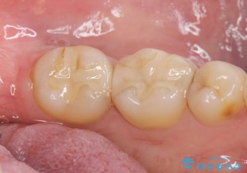 保険適応の白い詰め物レジンインレー下に再発した大きな虫歯治療の治療前