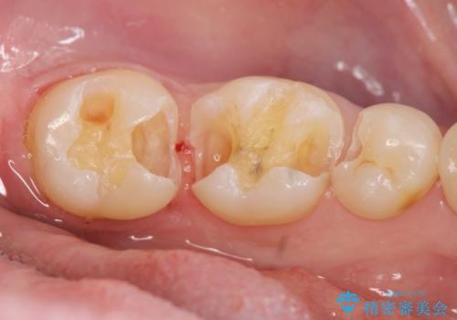 保険適応の白い詰め物レジンインレー下に再発した大きな虫歯治療の治療中