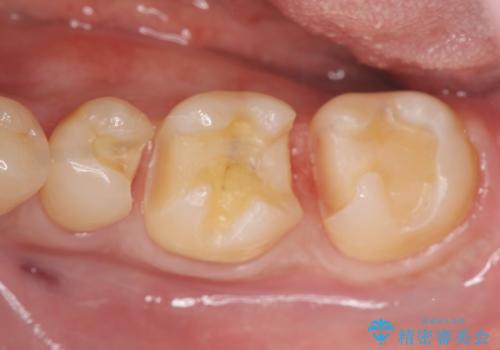 保険適応の白い詰め物レジンインレー下に再発した大きな虫歯治療の治療中