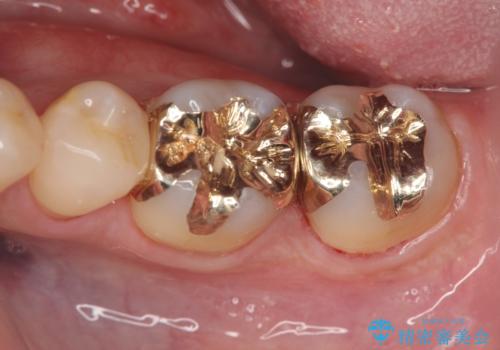保険適応の白い詰め物レジンインレー下に再発した大きな虫歯治療の症例 治療後