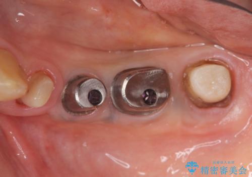 ブリッジ支台の歯の痛み インプラントによる咬合負担の治療中