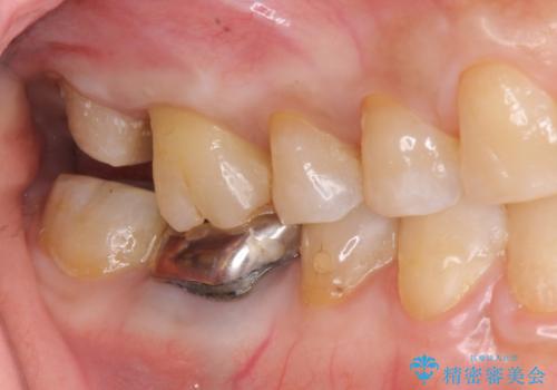 歯髄方向 歯肉方向へと深い 2種類の大きな虫歯の治療中