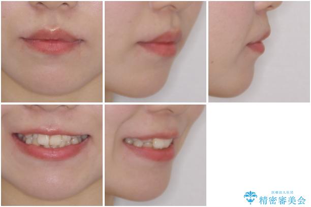 インビザライン矯正とインプラント治療と 総合歯科治療の治療前(顔貌)