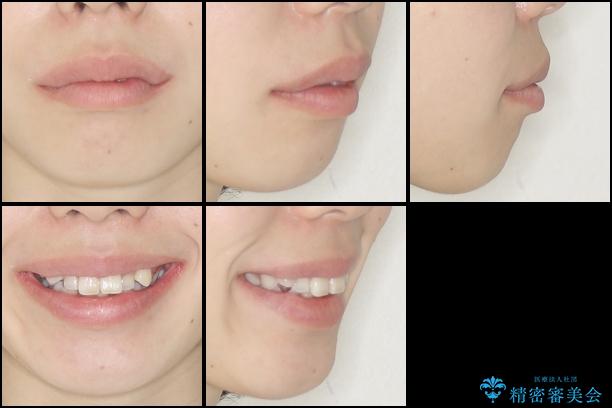 目立たない裏側矯正　抜歯矯正で口元を改善の治療前（顔貌）