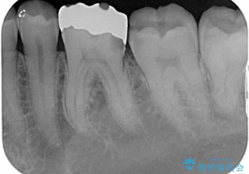 適合不良の銀のつめもの 保険と自費で白くの治療前