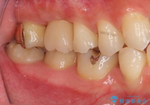 ソケットリフトを伴うインプラント補綴 の治療後