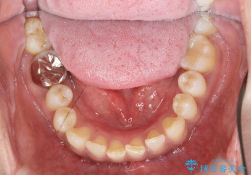 目立つ銀歯を白くしたい セラミック治療の治療前