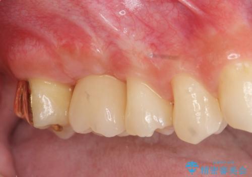 ソケットリフトを伴うインプラント補綴 の症例 治療後