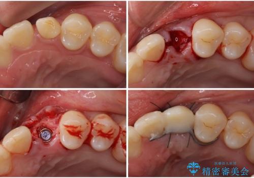 インビザライン矯正とインプラント治療と 総合歯科治療の治療中
