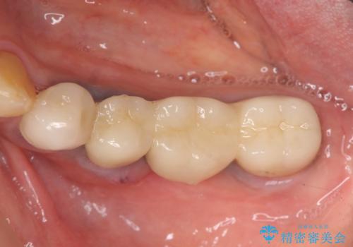 ブリッジ支台の歯の痛み インプラントによる咬合負担の治療前
