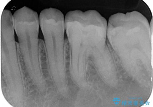 適合不良の銀のつめもの 保険と自費で白くの治療後