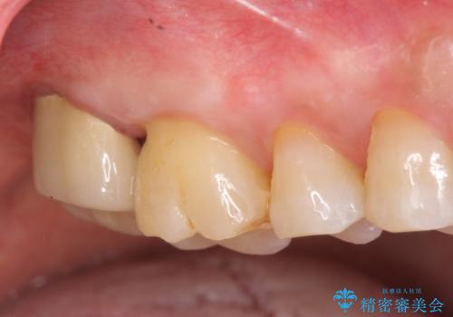 歯髄方向　歯肉方向へと深い 2種類の大きな虫歯の症例 治療後