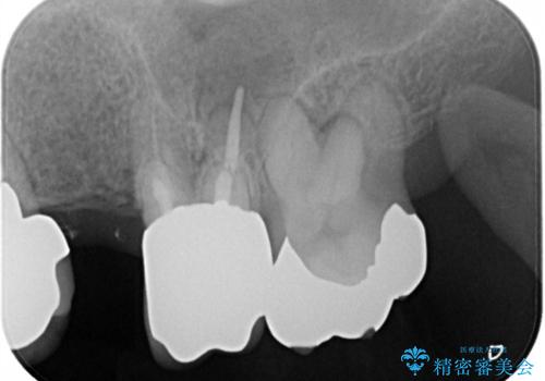 ノンクラスプデンチャー(金属止め具のない入れ歯)で左側の咬合回復の治療前