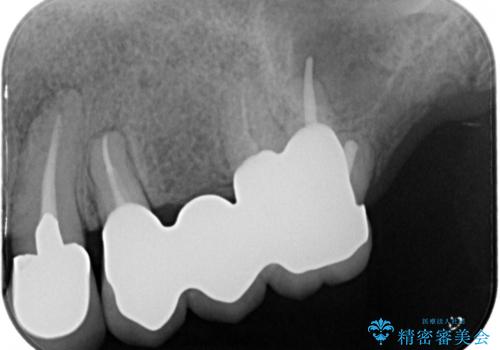 ノンクラスプデンチャー(金属止め具のない入れ歯)で左側の咬合回復の治療後