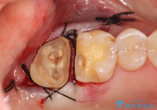 歯髄方向　歯肉方向へと深い 2種類の大きな虫歯の治療前