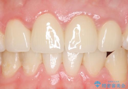 オールセラミッククラウン 前歯を綺麗に 神経が死んだ歯の再治療~補綴の治療後