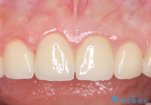 オールセラミッククラウン 前歯を綺麗に 神経が死んだ歯の再治療~補綴の症例 治療後