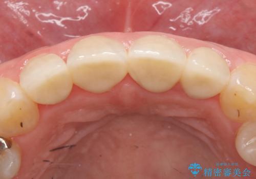 オールセラミッククラウン 前歯を綺麗に 神経が死んだ歯の再治療~補綴の治療後