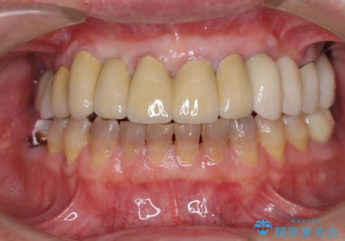 [歯周病治療]  歯周補綴　インプラント補綴の治療後
