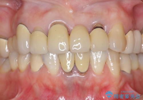 前歯ブリッジのやりかえの治療前