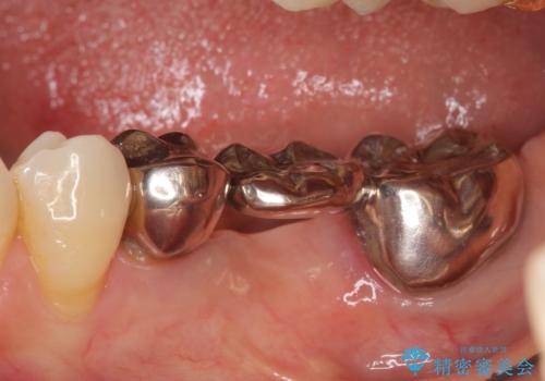 オールセラミッククラウン 欠損補綴と再生療法による深いポケットの改善の治療前