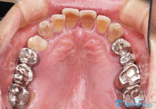 [歯周病治療]  歯周補綴　インプラント補綴の症例 治療前